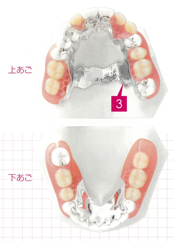 ノンクラスプデンチャーとは？